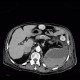 Hematoma in psoas muscle, large, anticoagulation therapy, anticoagulant: CT - Computed tomography